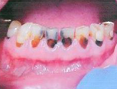 Decayed and worn teeth replaced with eight empress crowns