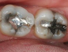 Two amalgam fillings replaced with tooth colored CEREC onlays in a single appointment. 
