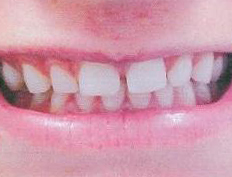 Eight veneers close space between teeth creating a beautiful smile