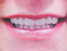Eight veneers close space between teeth creating a beautiful smile