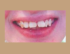 Protruding and teeth replaced with a porcelain bridge