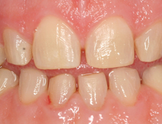 Upper and lower veneers transform this smile