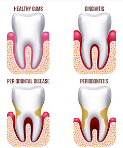 Types of Dental Fillings - Eagle Harbor Dentist
