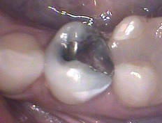 CEREC onlay replaces an old amalgam filling with a perfectly matched restoration in just one single office visit!