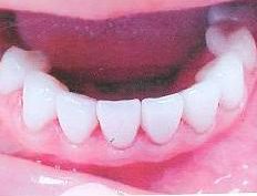 Decayed and worn teeth replaced with eight empress crowns
