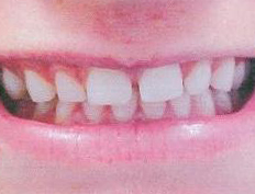 Eight veneers close space between teeth creating a beautiful smile