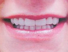 Eight veneers close space between teeth creating a beautiful smile